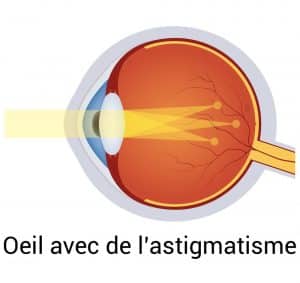 Oeil avec de l' astigmatisme